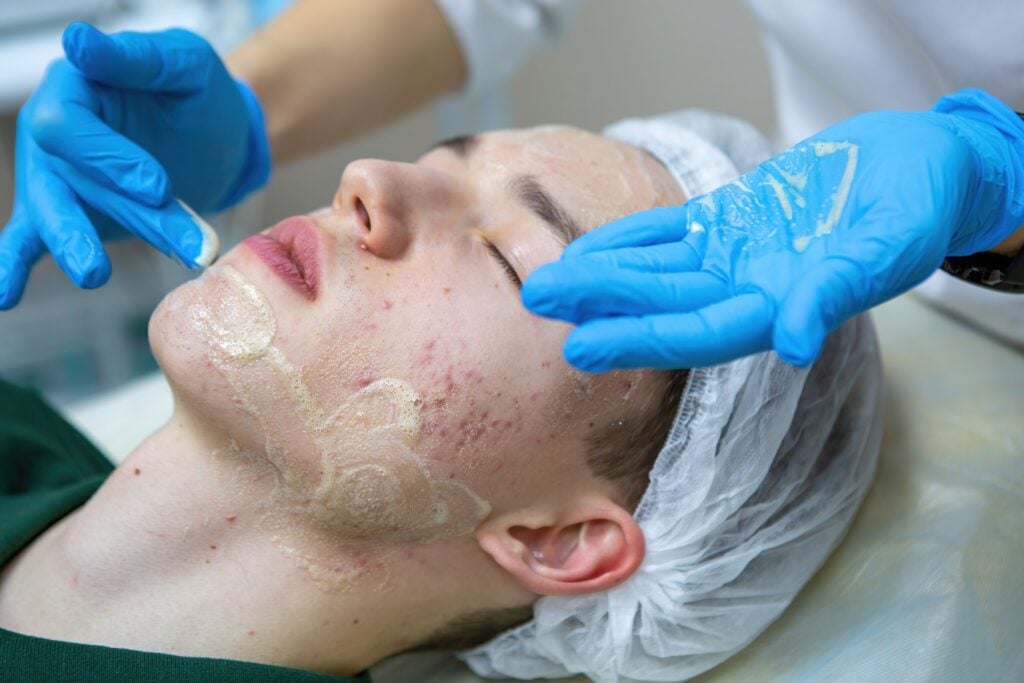 UMI Clear Skin Acne Facial 90 Min